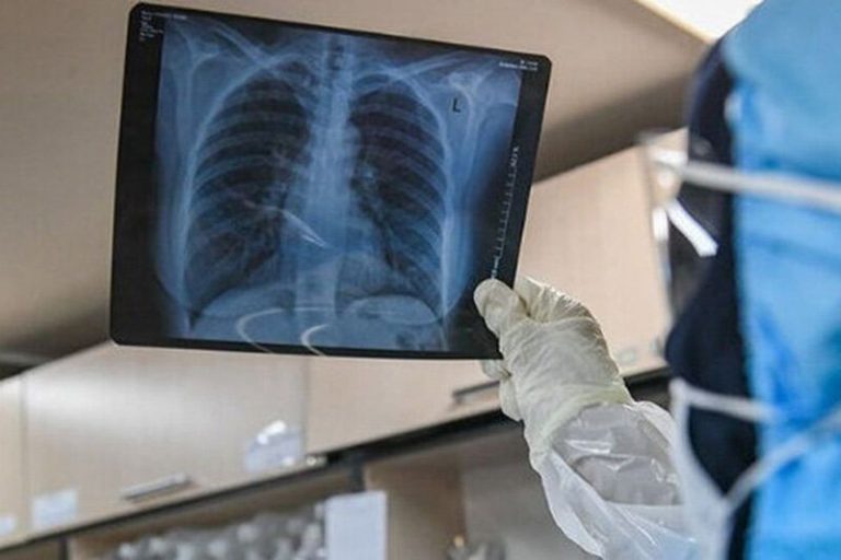 ببینید | نشانههای درگیری ریه در مبتلایان به ویروس کرونا