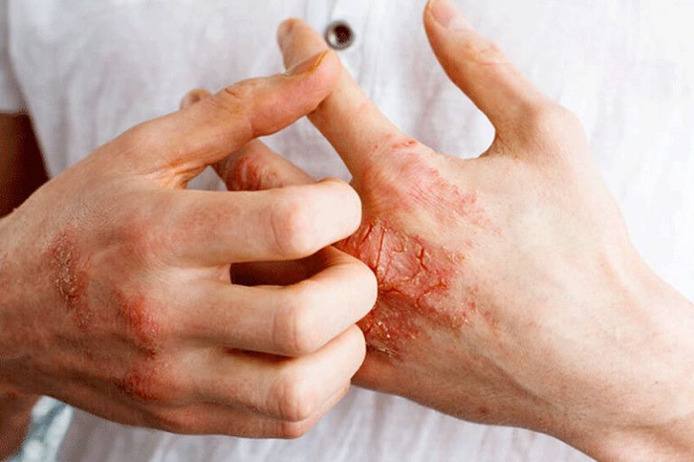 اینفوگرافیک | علائم و راهکارهای خانگی برای درمان اگزما