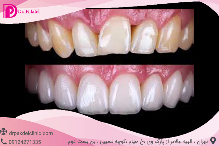 Dental composite-1