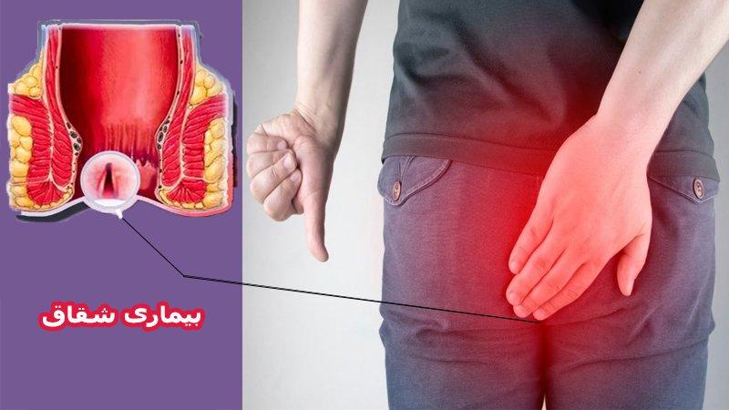 تفاوت شقاق حاد و مزمن و گزینههای درمان این بیماری