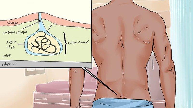 علائم کیست مویی چیست + بهترین راه درمان