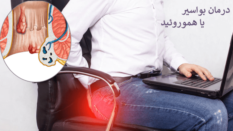 علائم هموروئید داخلی و خارجی؛ روش‌های درمان
