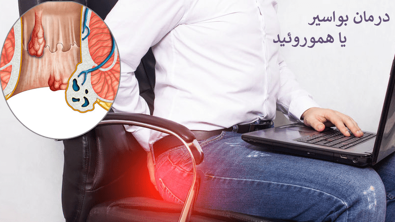علائم هموروئید داخلی و خارجی؛ روشهای درمان