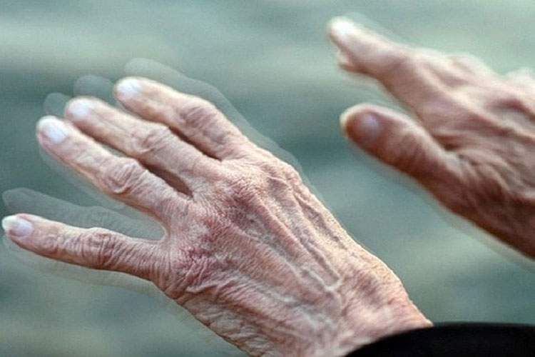 هوش مصنوعی به کمک تشخیص پارکینسون میآید