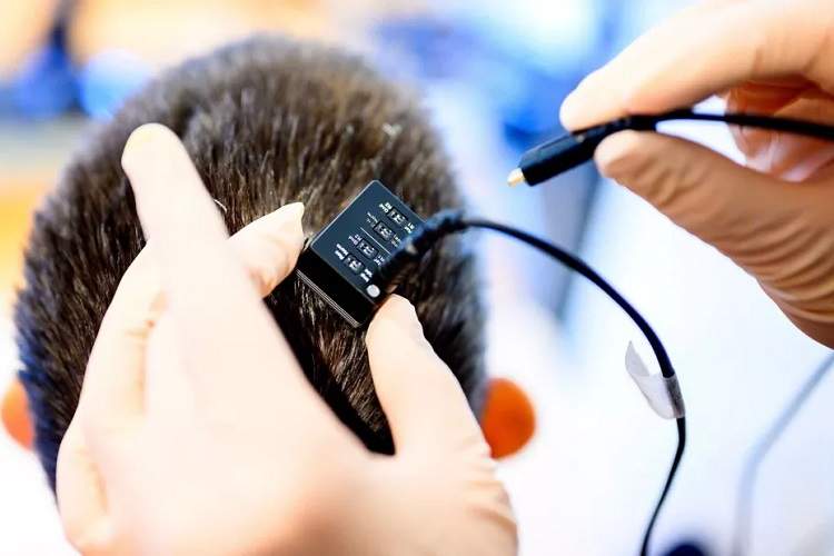 تحولی در فناوری گفتار مصنوعی: بازگشت صدای بیماران فلج با هوش مصنوعی