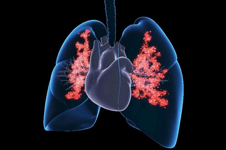 رژیم غذای پرچرب و پرکربوهیدرات ممکن است خطر سرطان ریه را افزایش دهد