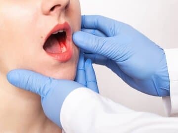 اصلیترین عوامل خطر در سرطان دهان چیست؟/ علائم هشدار دهنده