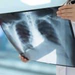 ارتباط رژیم غذایی و سرطان ریه: نقش حیاتی قند در رشد تومور