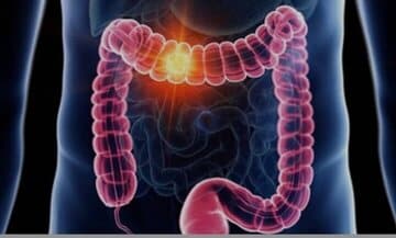 علائم گوارشی را ساده نگیرید/ هر خونریزی هموروئید نیست