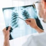 چرا آنفلوآنزا گاهی کشنده میشود؟