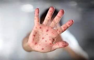 گزارش جدید سازمان جهانی بهداشت از شیوع سرخک