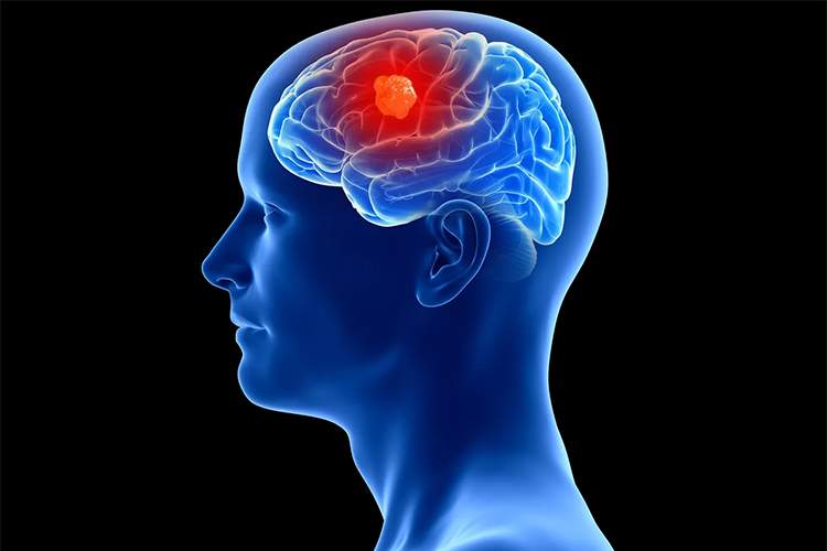 فناوری شگفتانگیز در مغز انسان؛ دستگاهی برای شناسایی تومورهای سرطانی